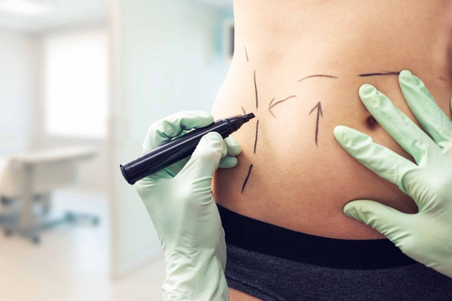 Laser Liposuction