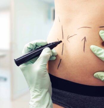Lipo_WEB-768x512 Laser Liposuction