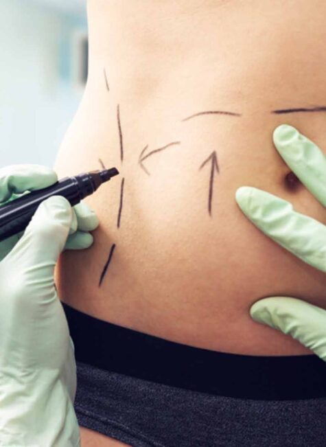 Lipo_WEB-768x512 laser liposuction utah